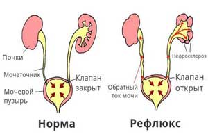 пузырно-мочеточниковый рефлюкс