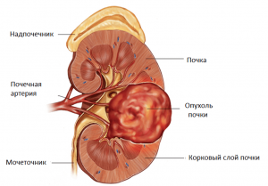 лечение рака почки