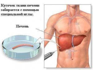 лечение рака печени