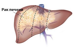 симптомы рака печени