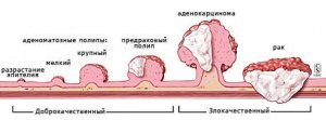 Лечение Рака ануса в Израиле