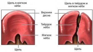 cleft_palate