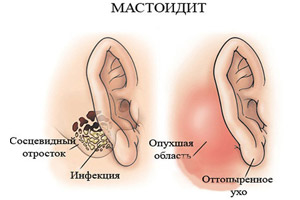 мастоидит