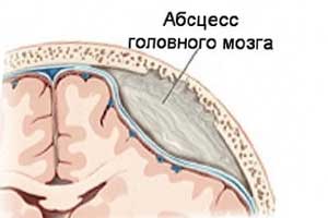 абсцесс головного мозга