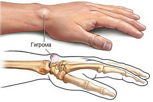 гигрома