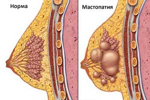 мастопатия