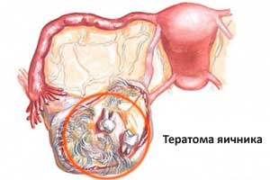 тератома 