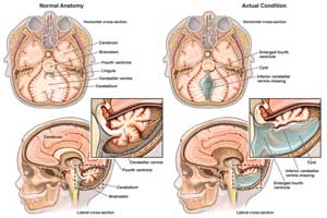 синдром Денди-Уокера