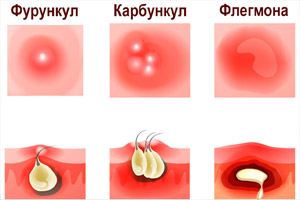 флегмона
