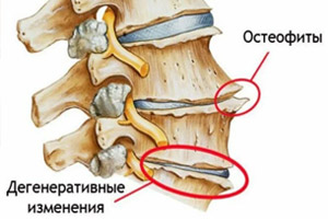 остеофит